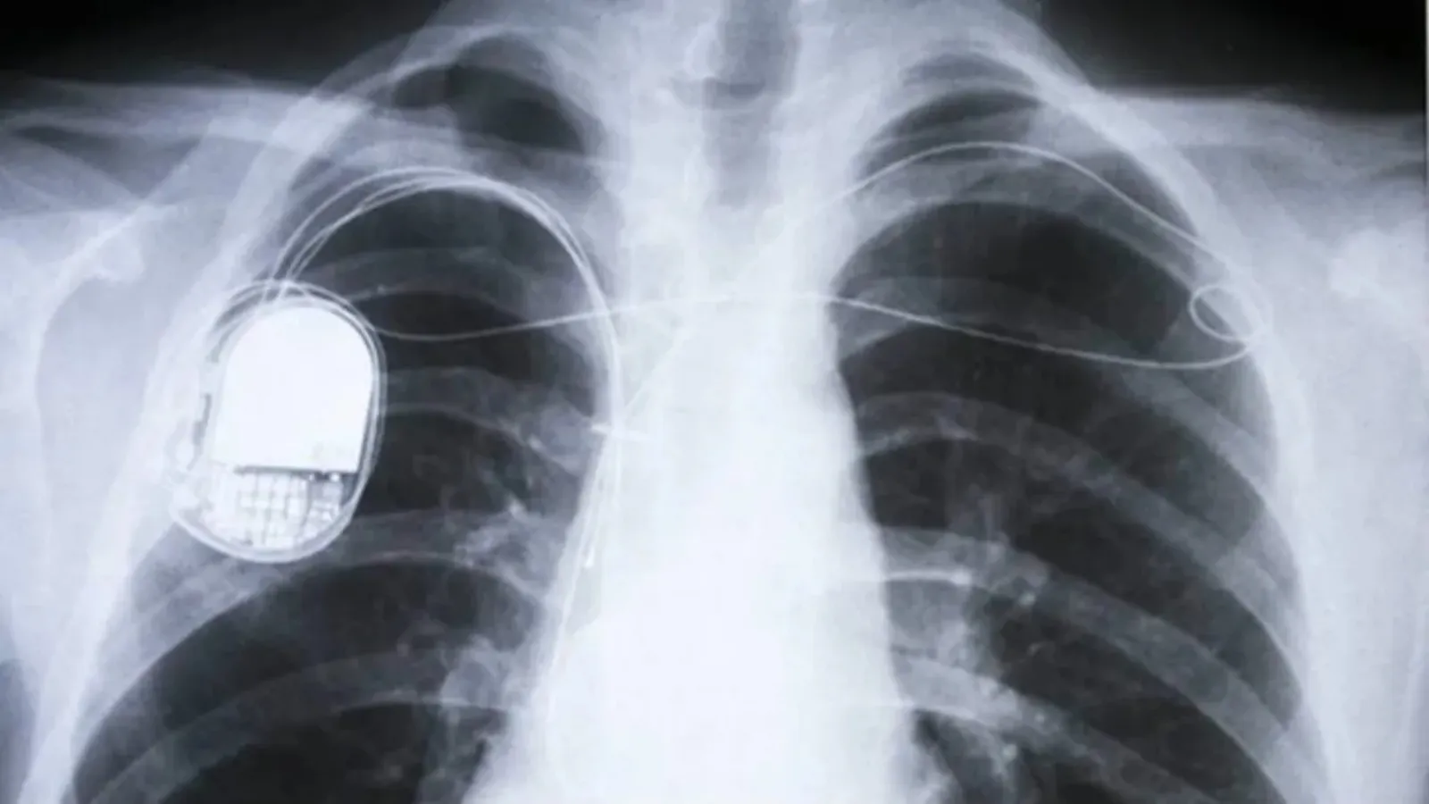 At 63, she needed a pacemaker, which got infected. What saved her?