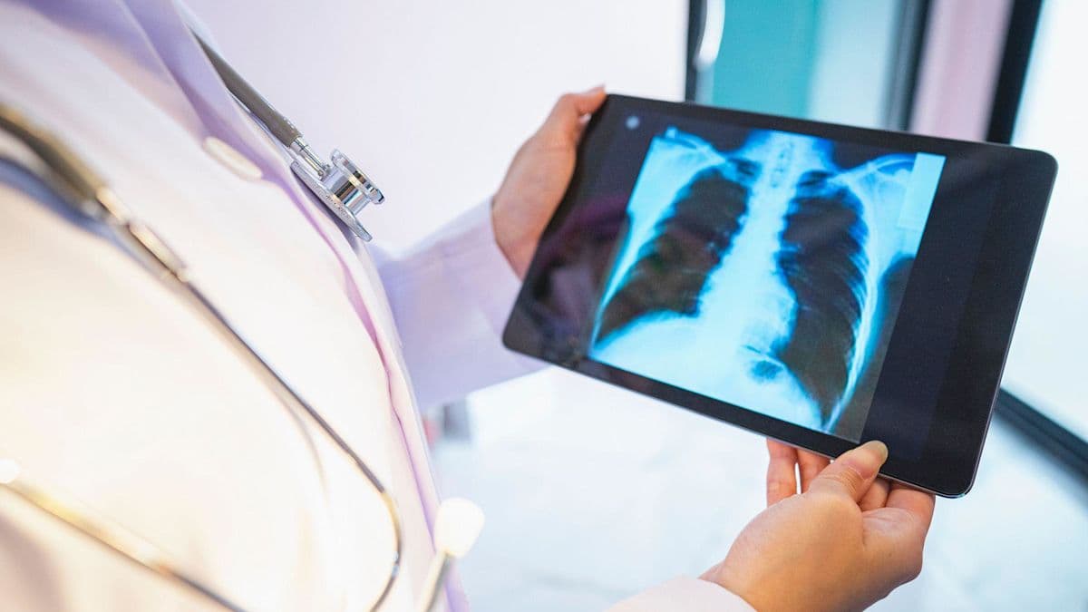 Lung cancer screening sees 10,000 people take part