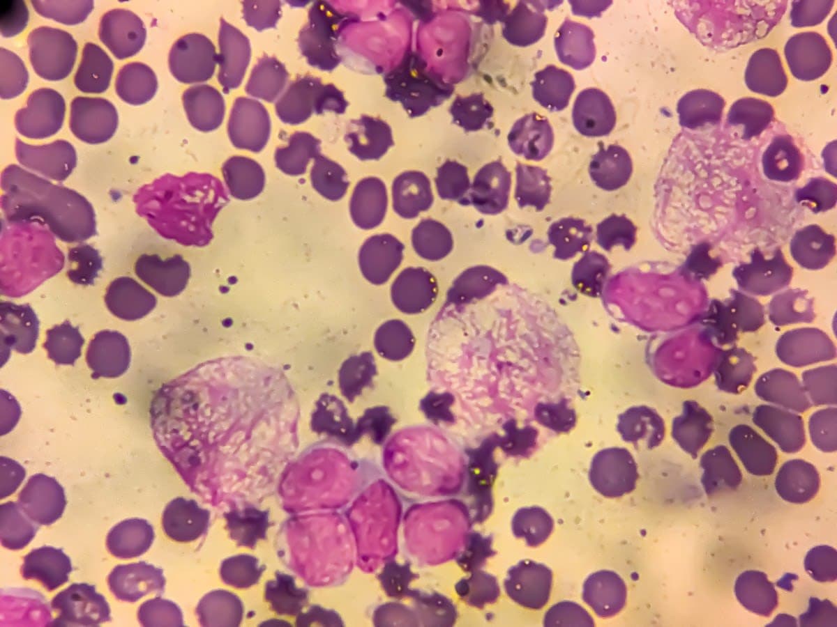 1 in 8 cancer cases worldwide linked to infections